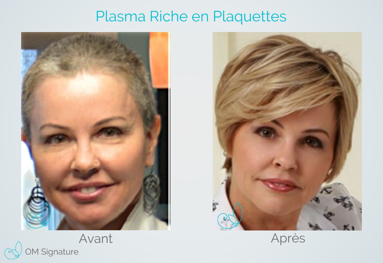 Perte Cheveux Localisée Femme  Les pertes de cheveux chez la femme